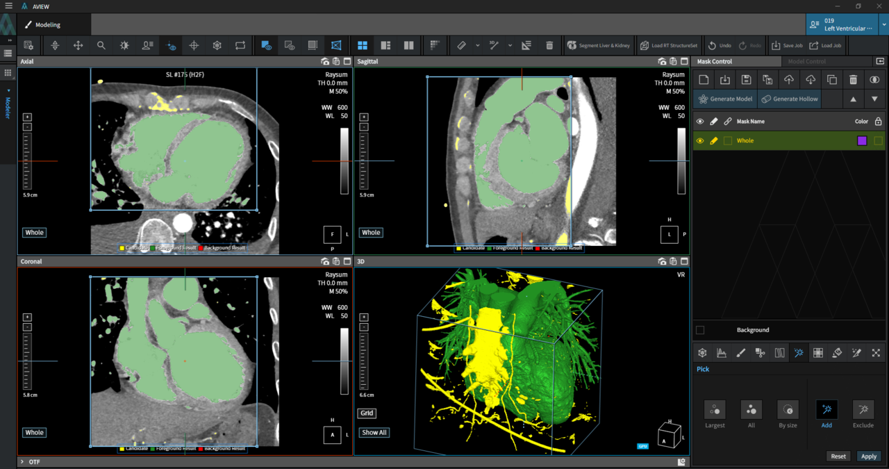 3mm 간격의 영상으로 구성한 척추뼈 모델(왼쪽)과 AI로 복원한 1mm 척추뼈 모델. 척추와 척추 사이의 중요 구조물이 세밀하게 표현돼 척추 사이에 이식하는 척추간 임플란트를 보다 정밀하게 디자인할 수 있다.