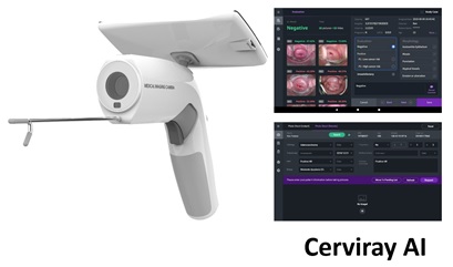 아이도트가 자체 개발한 콜포스코프 카메라, 자궁경부암 초기 진단 AI 시스템