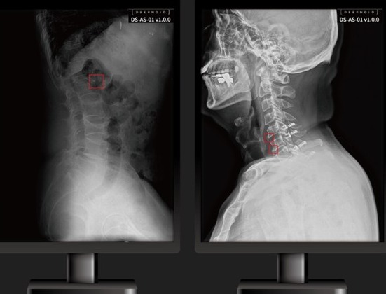 딥노이드의 척추 부위 의료영상 AI 솔루션 ‘딥스파인’이 식약처로부터 의료영상분석 소프트웨어 인증을 획득했다. [사진=딥노이드]